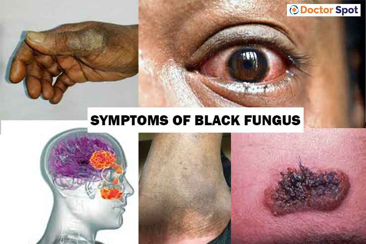 Types of Black fungus disease Mucormycosis symptoms