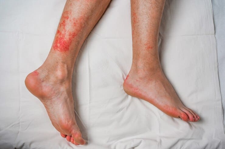 male-leg-itching-red-rash-caused-by-insect-bites-bites-health-medical-surveillance--