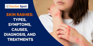 Skin Rashes: Types, Symptoms, Causes, Diagnosis, and Treatments