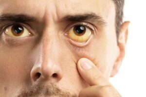 Jaundice - yellowish-eyes-is-sign-problems-with-liver-viral-infection