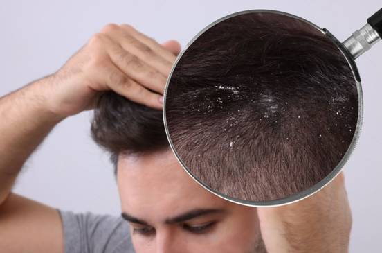 Is Dandruff Contagious