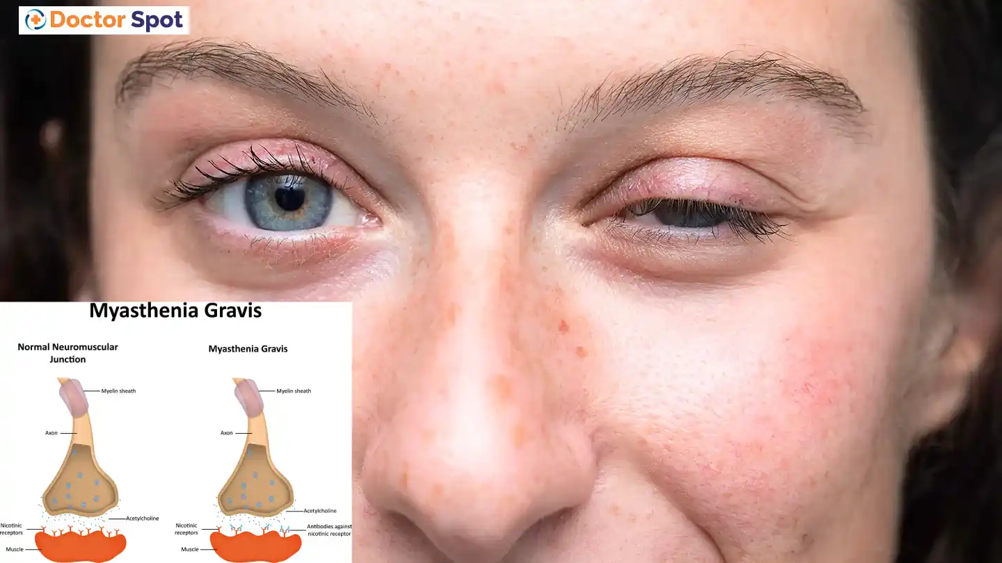 Myasthenia Gravis Symptoms, Causes, Diagnosis, and Treatment