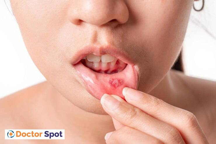 Natural Remedies to Cure Mouth Ulcers