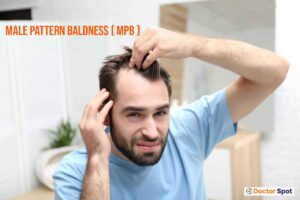 male pattern baldness ( MPB )
