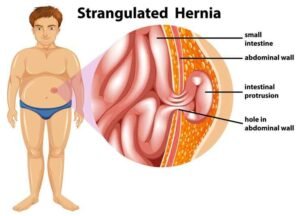 man-strangulated-hernia