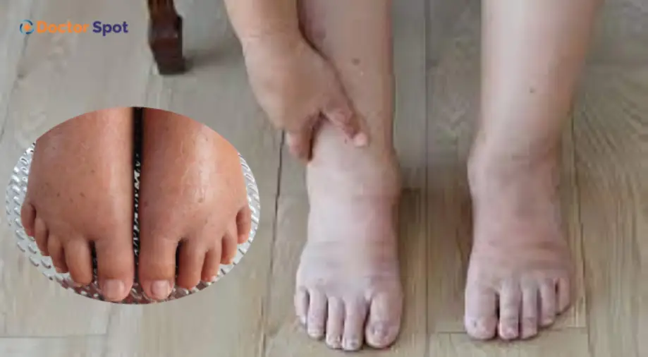 Silent Killer' Pancreacic Cancer A Surprising Warning Sign Can Show Up in Your Legs