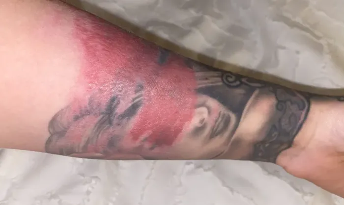 Why Does My Tattoo Burn Causes, Treatment, and When to Worry