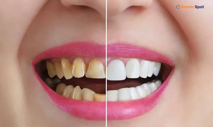 Safe Teeth Whitening at Home Tips That Actually Work