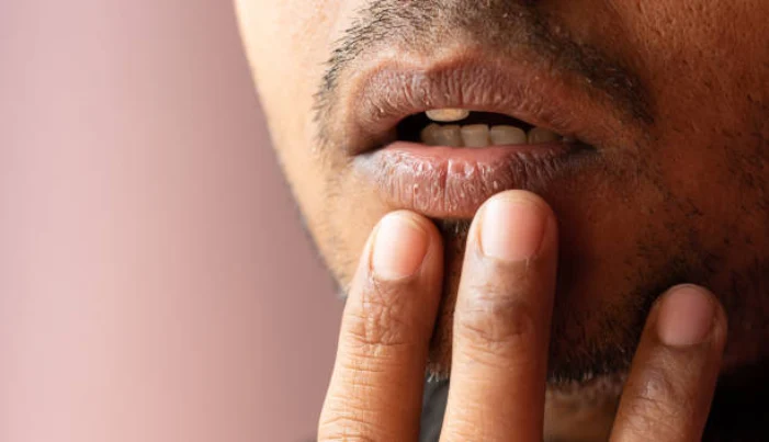 dry mouth - dry lips